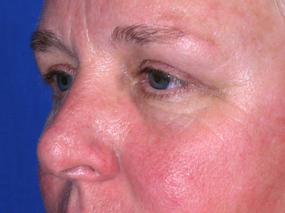 Case #19079 after left oblique