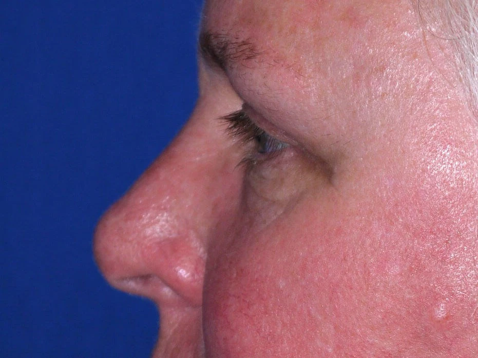 Case #19079 after left side