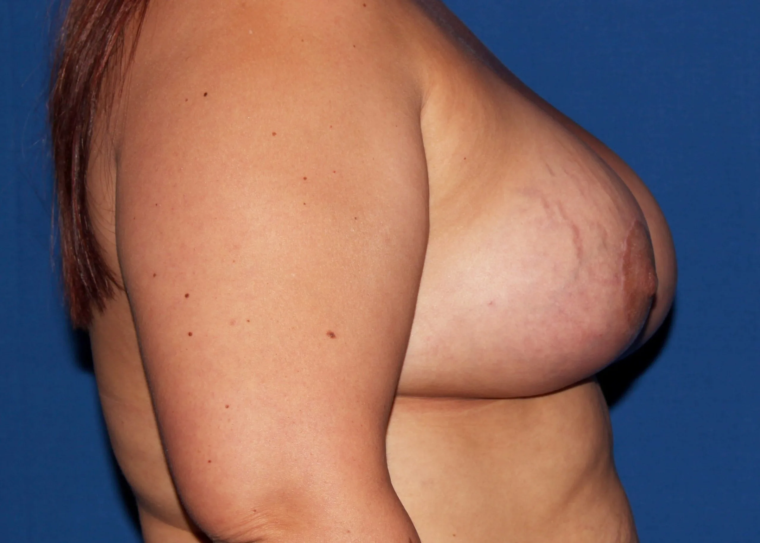 Case #33424 After right side