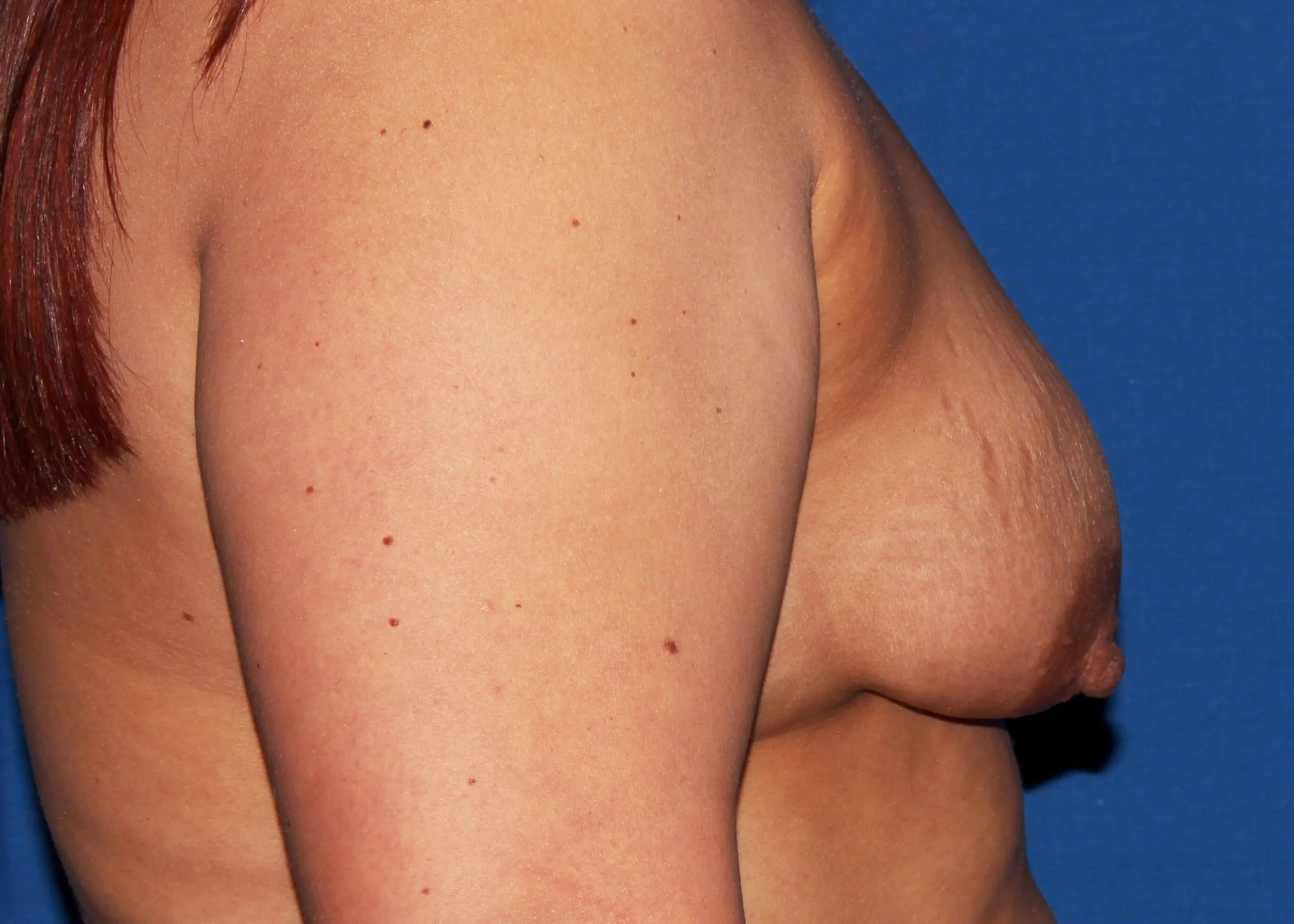 Case #33424 before right side