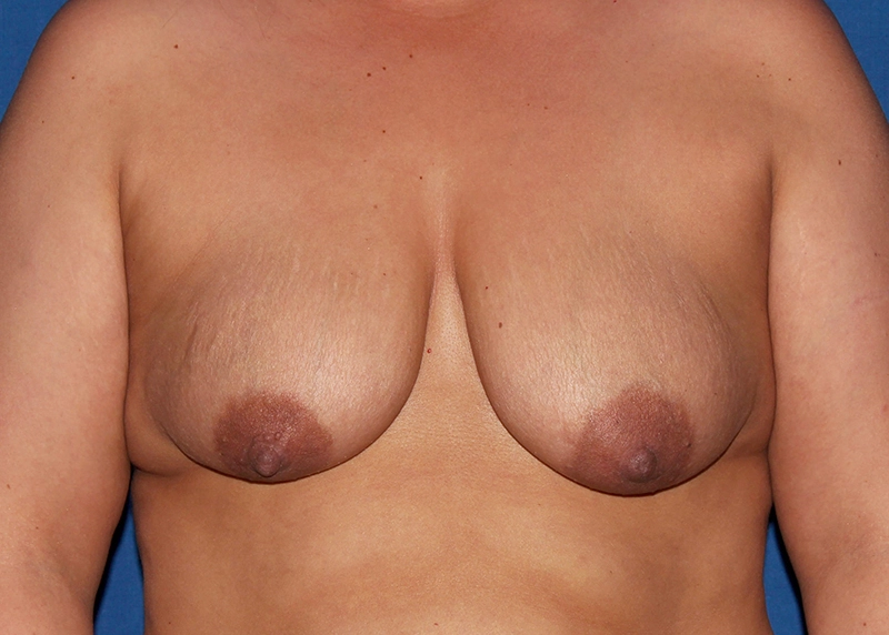 Case #33424 before_opt