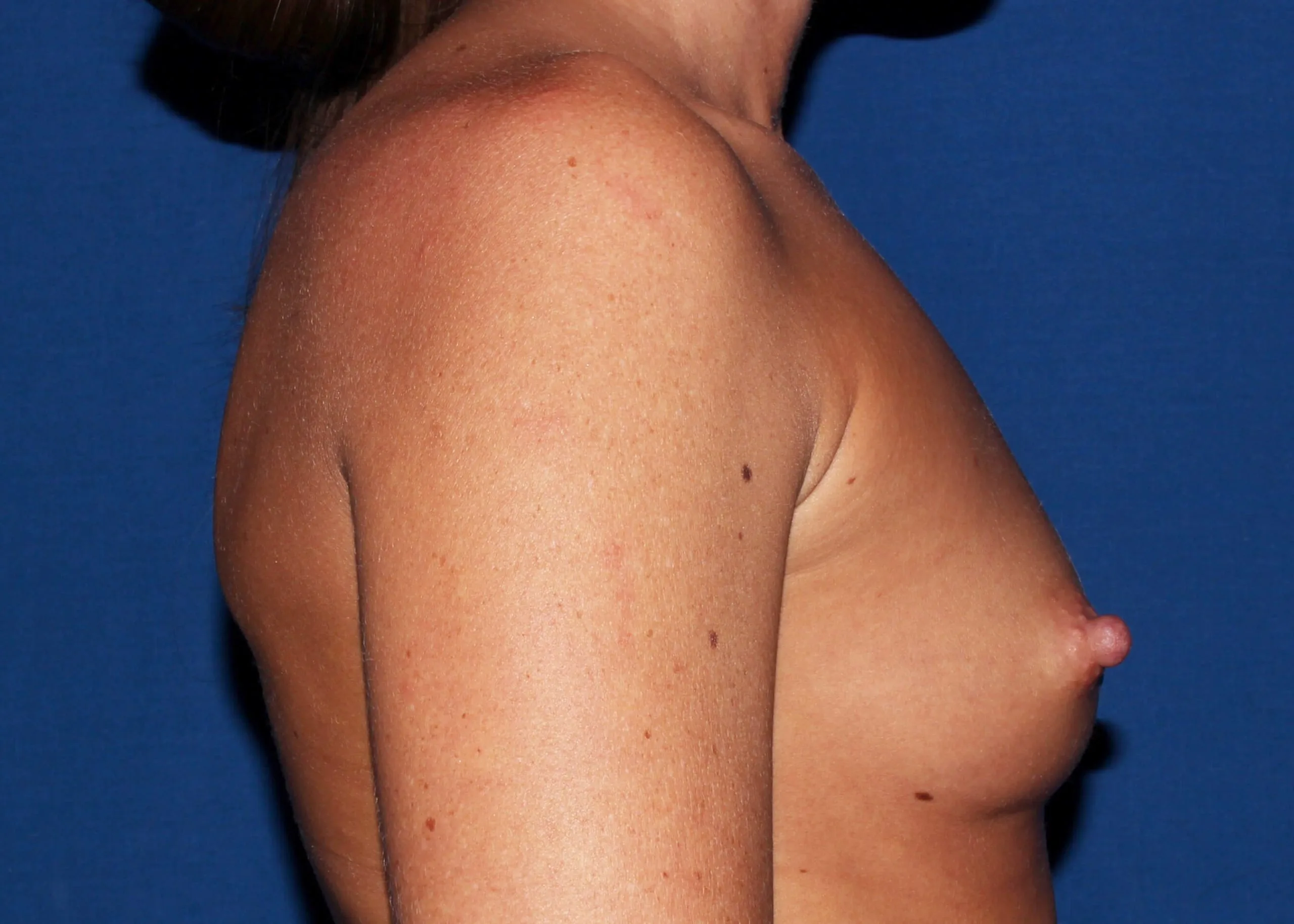 Case #33432 before right side