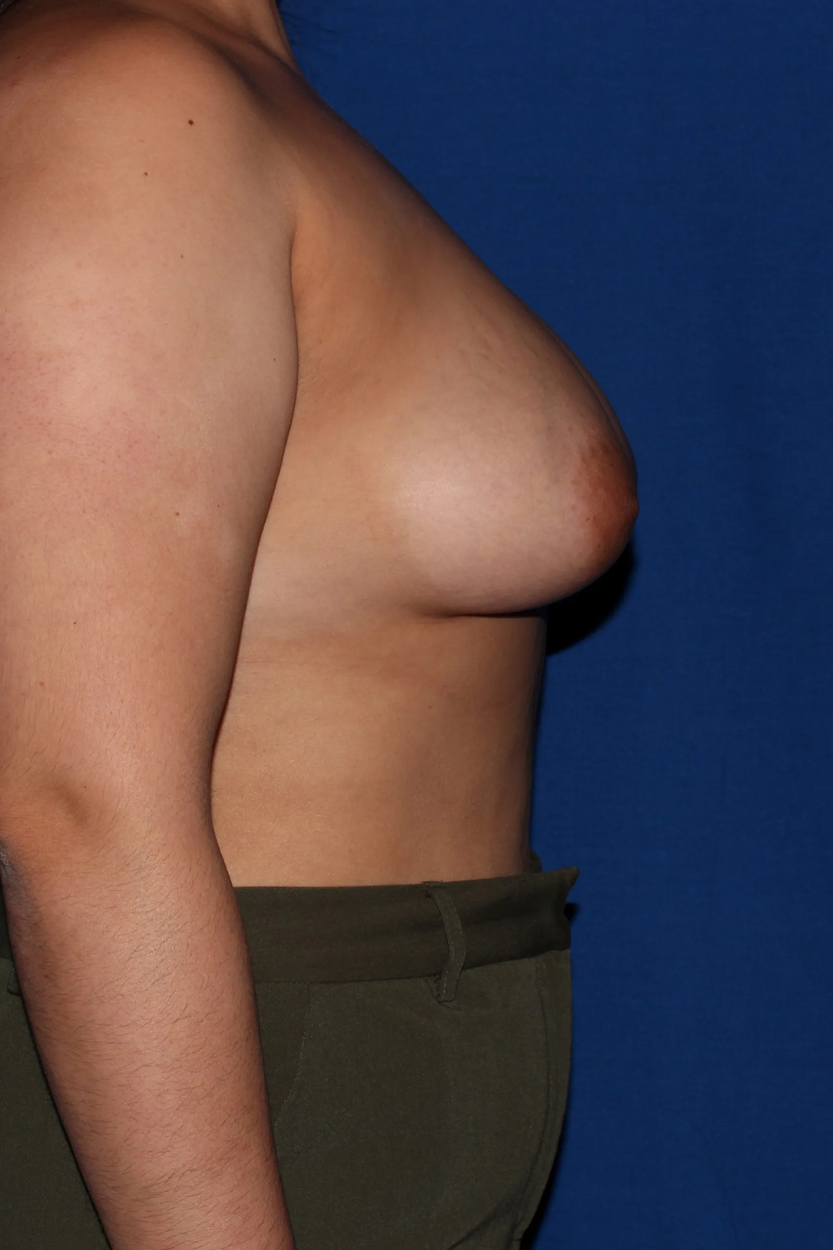 Case #3431 before side