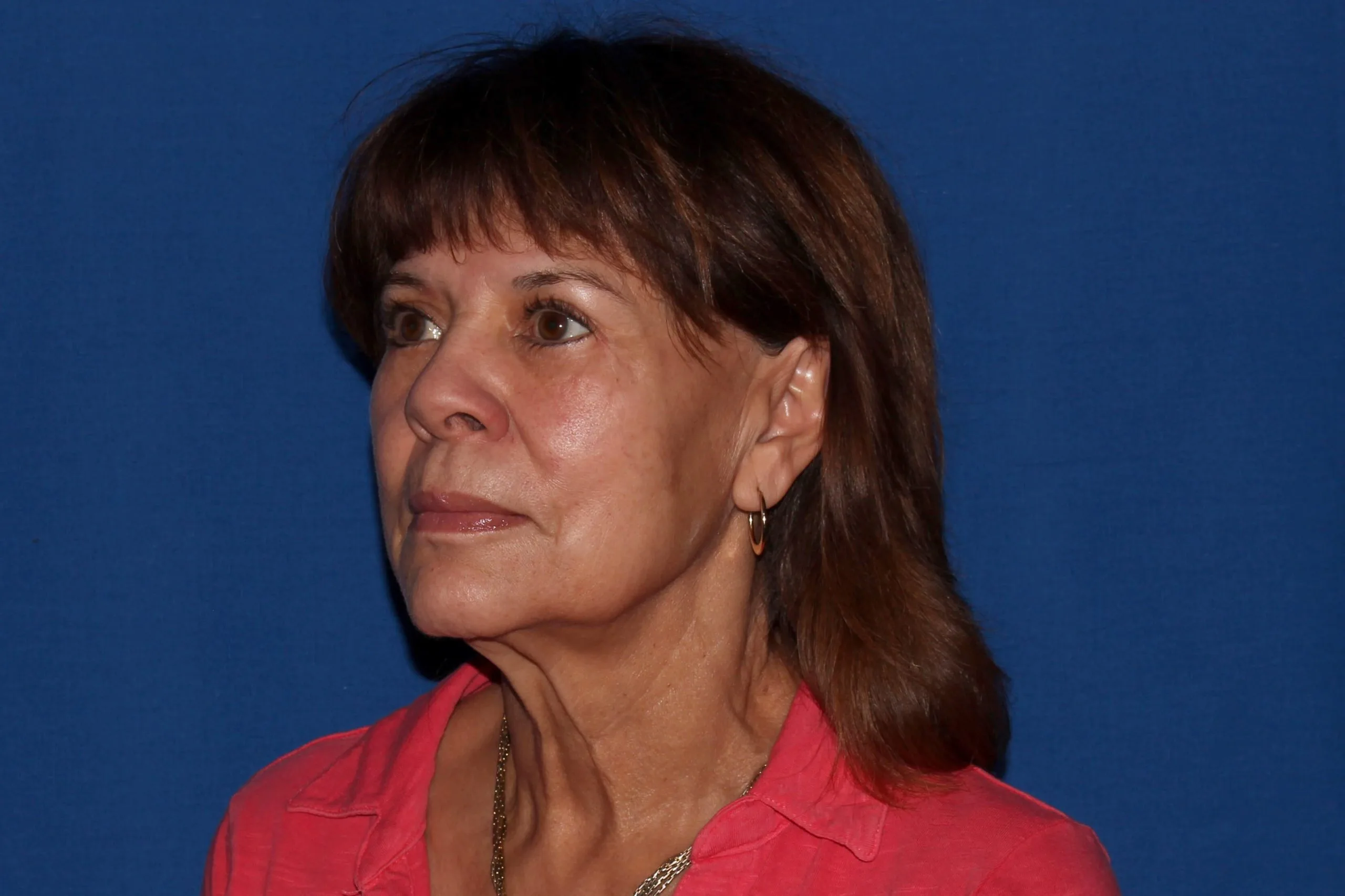 Case #35049 before left oblique