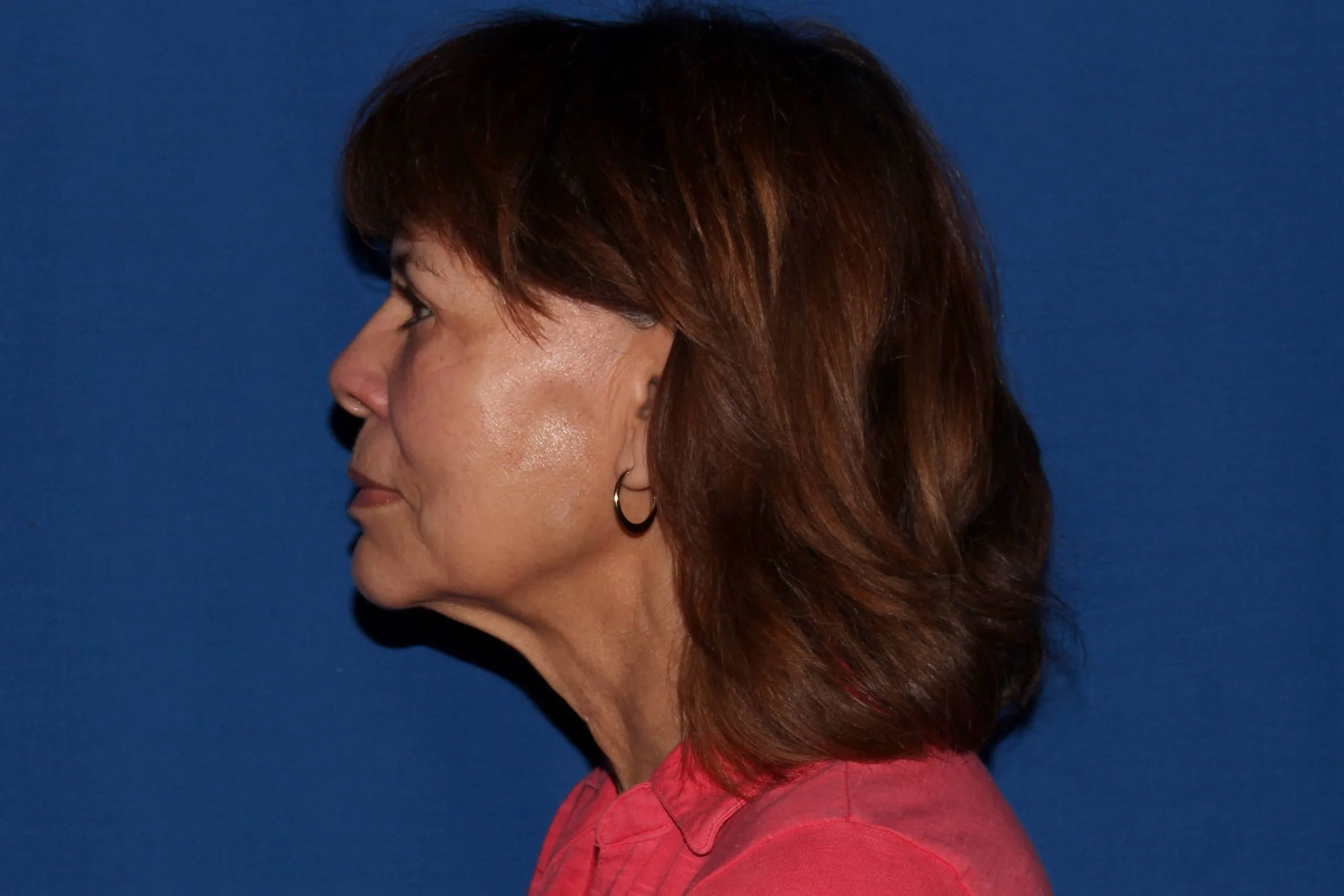 Case #35049 before left