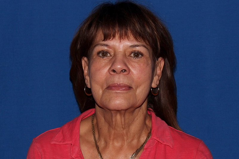 Case #35049 before_opt