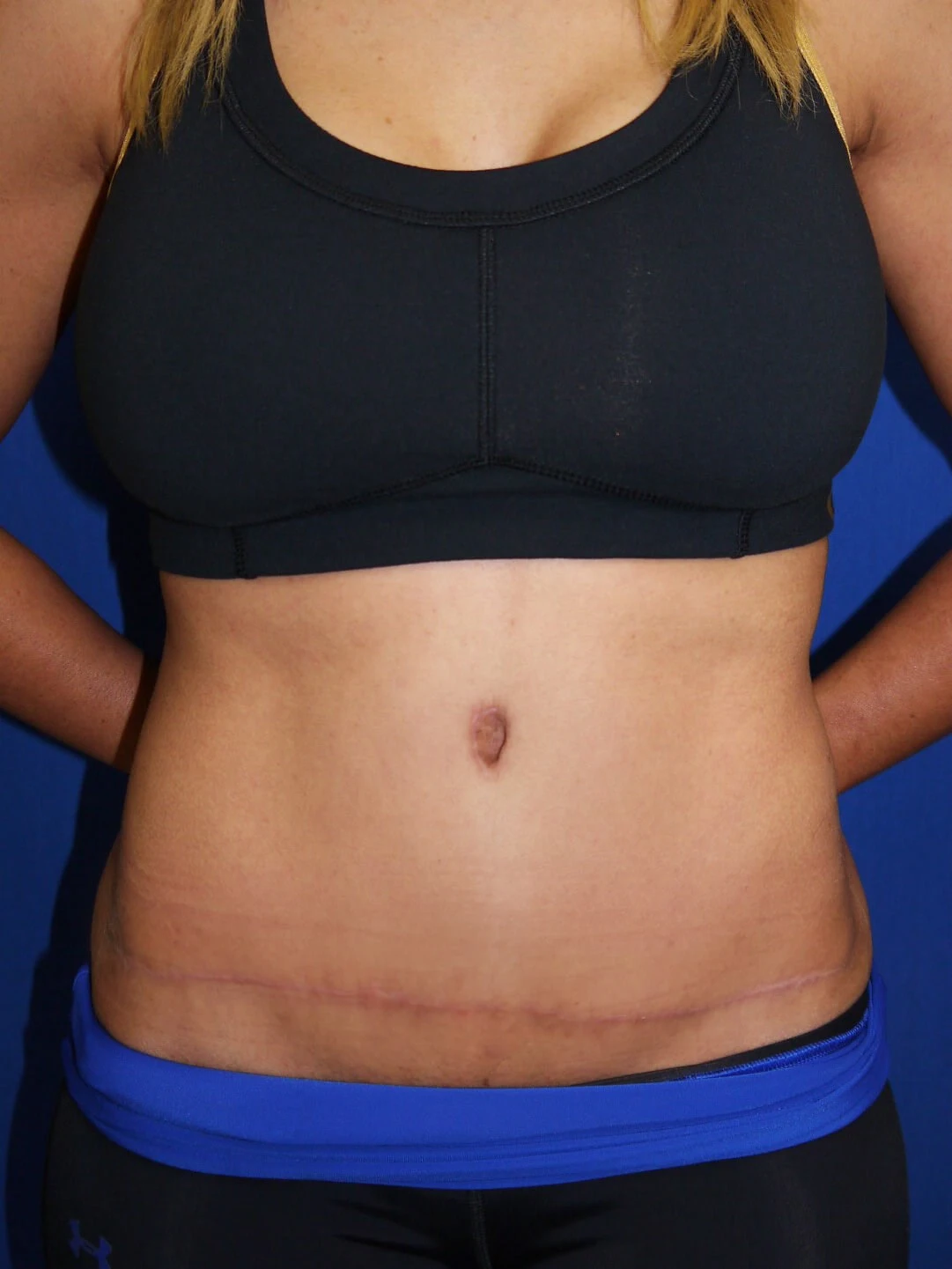 Case #36211 After front