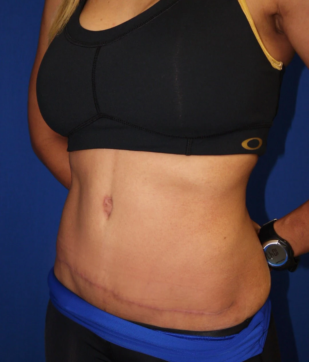 Case #36211 After left oblique