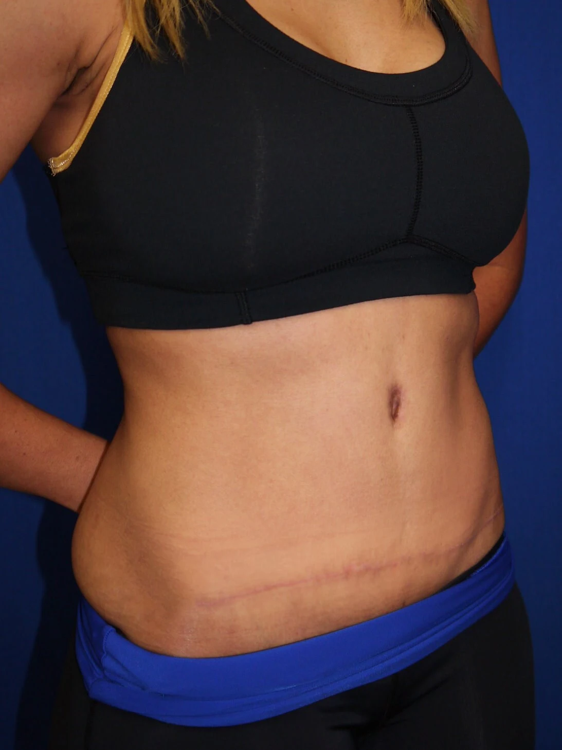 Case #36211 After right oblique