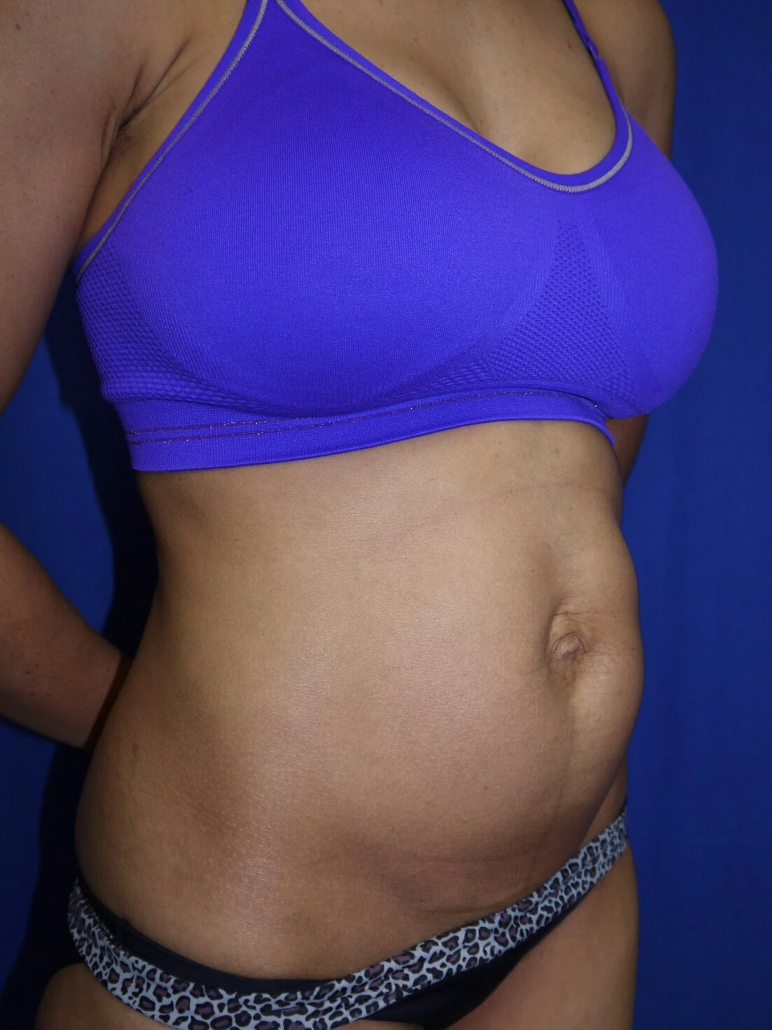 Case #36211 Before right oblique