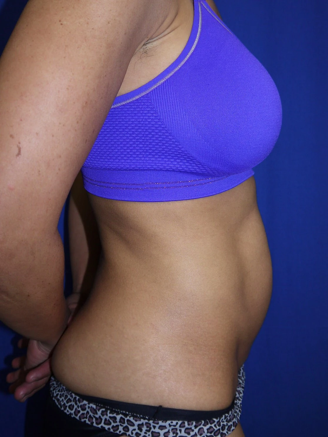 Case #36211 Before right view