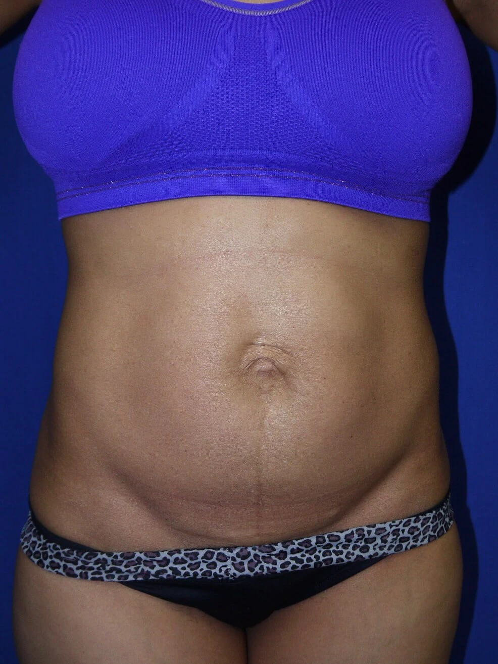 Case #36211 before front