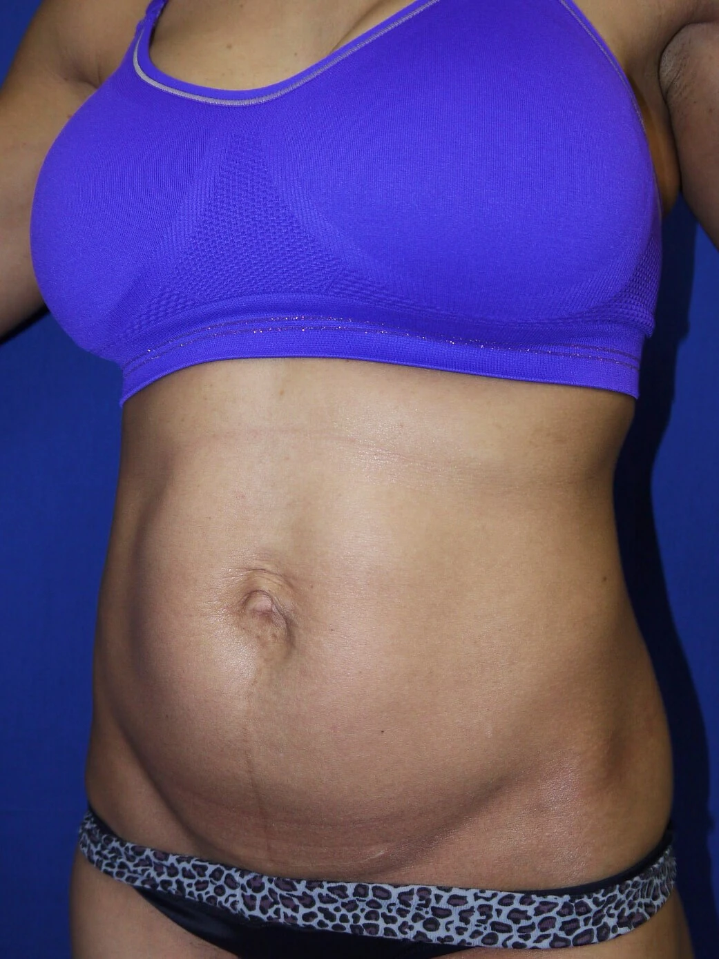 Case #36211 before left oblique