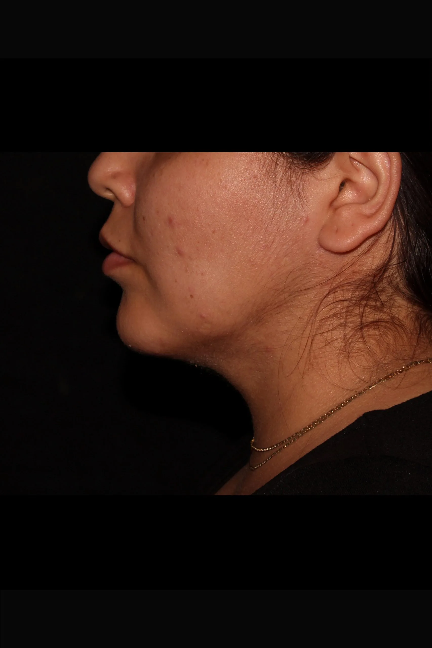 Case #5343 _after_side