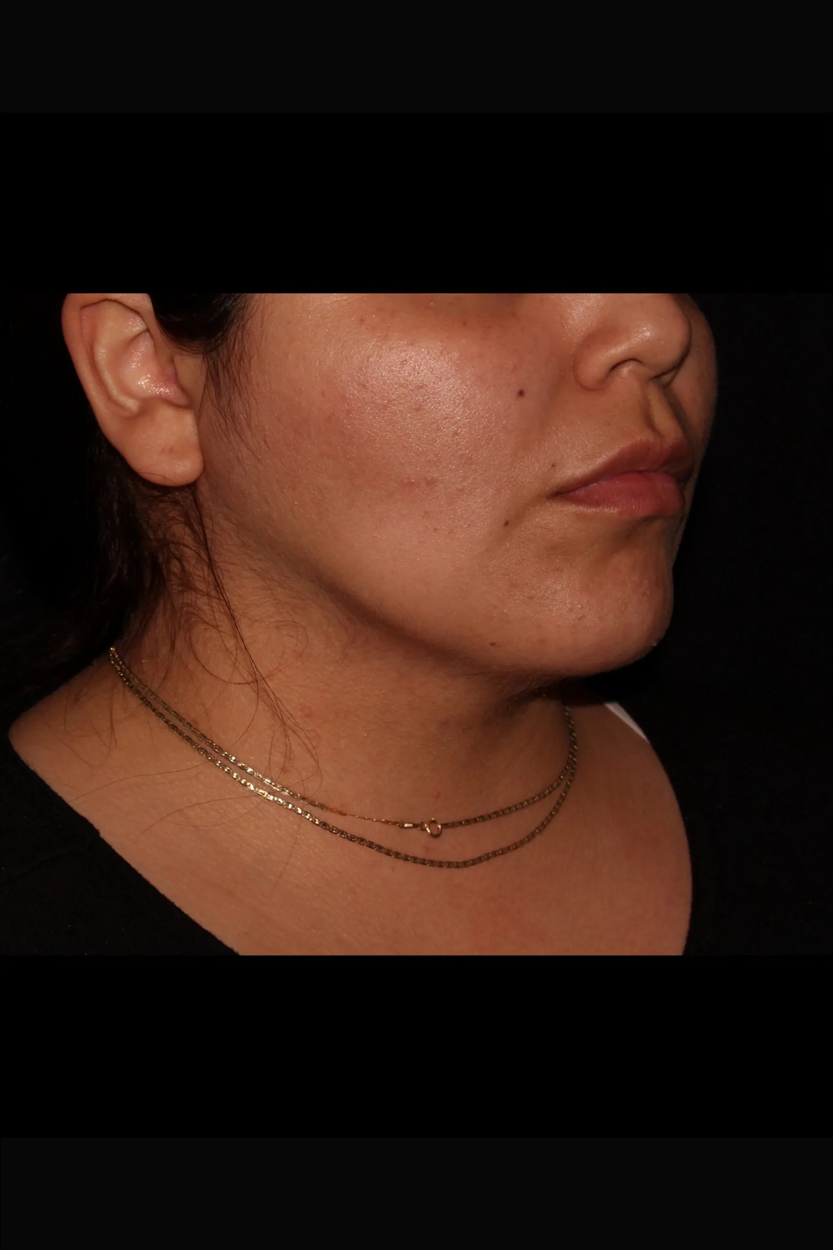 Case #5343 after_oblique