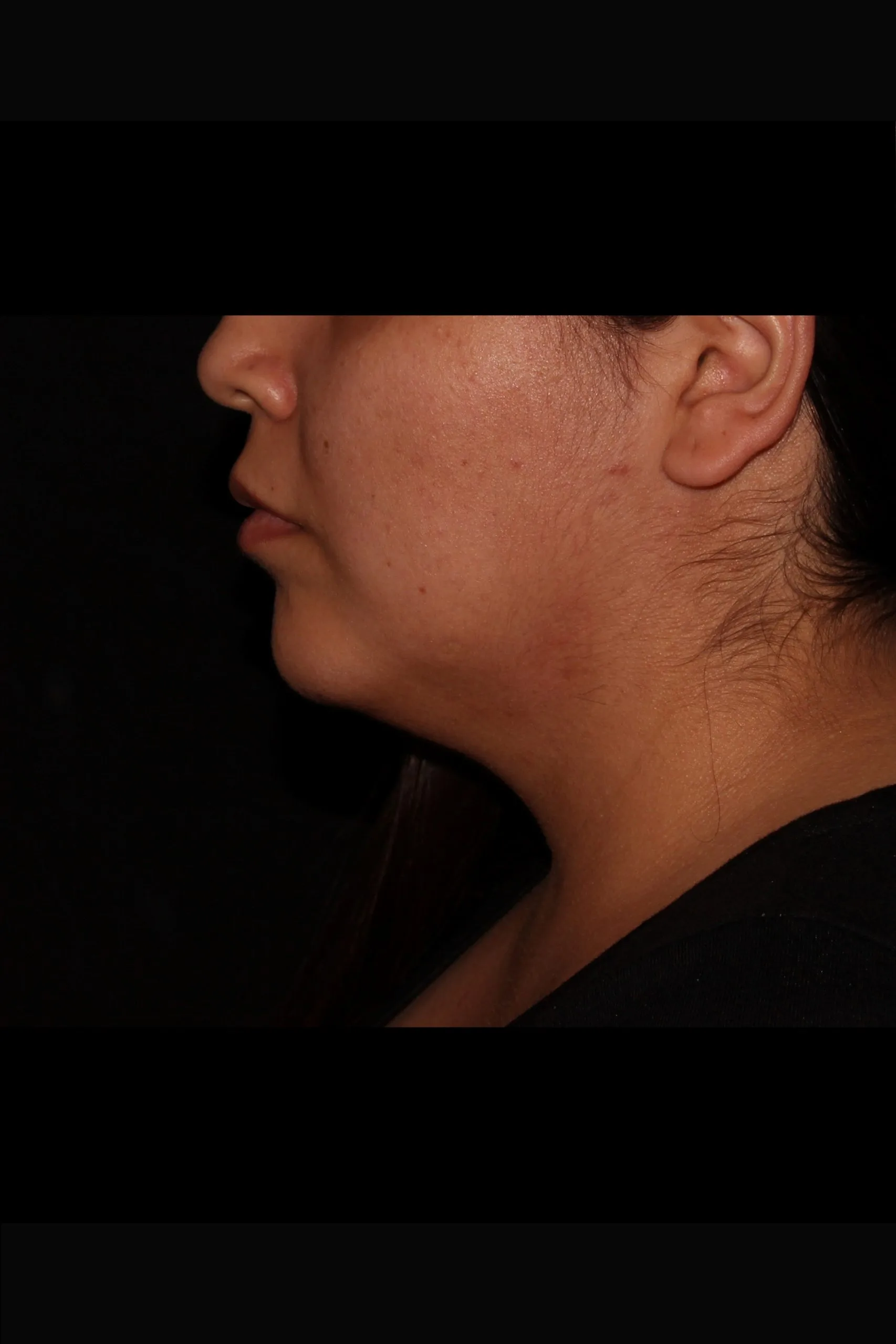 Case #5343 before_side