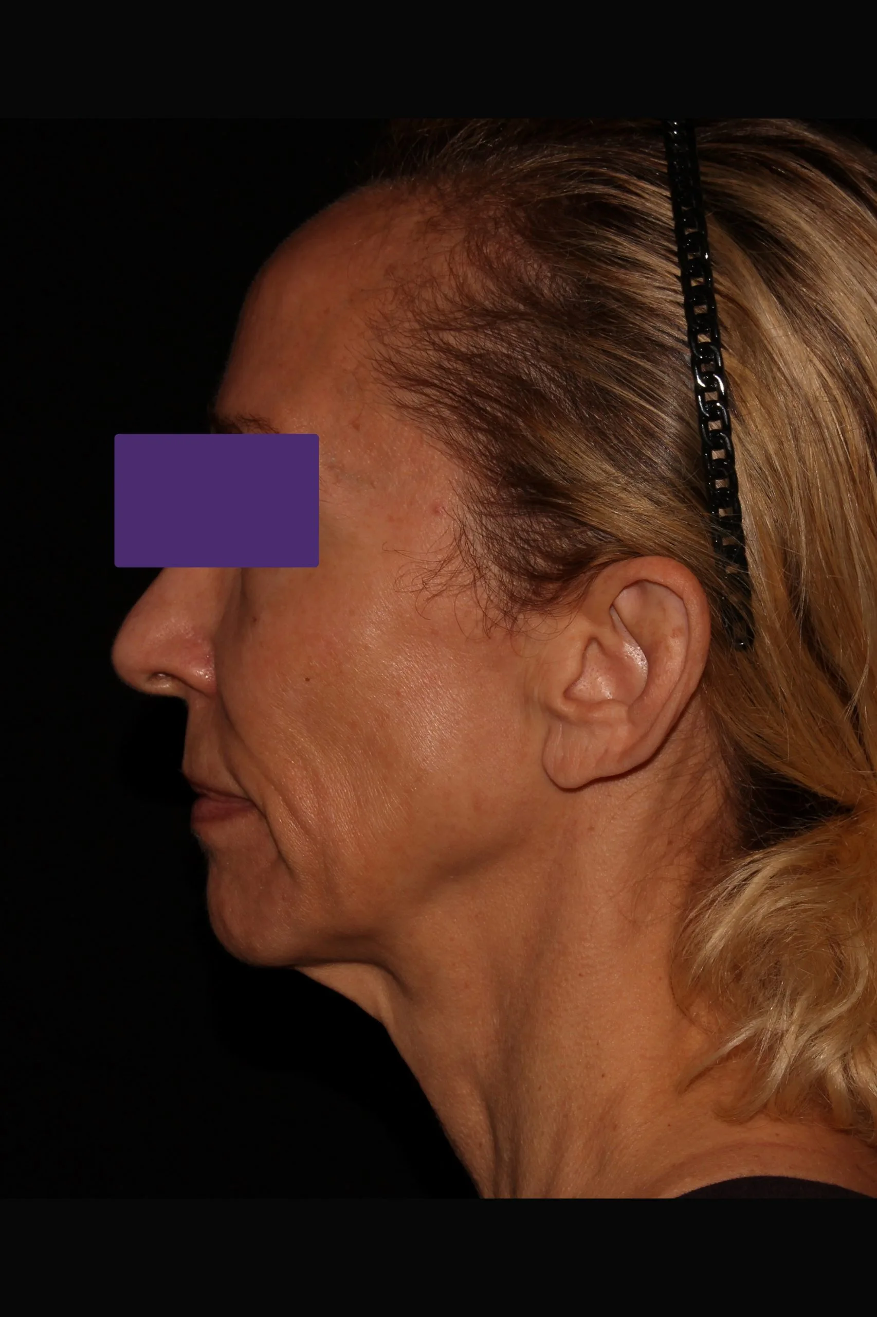 Case #5582 _before_side