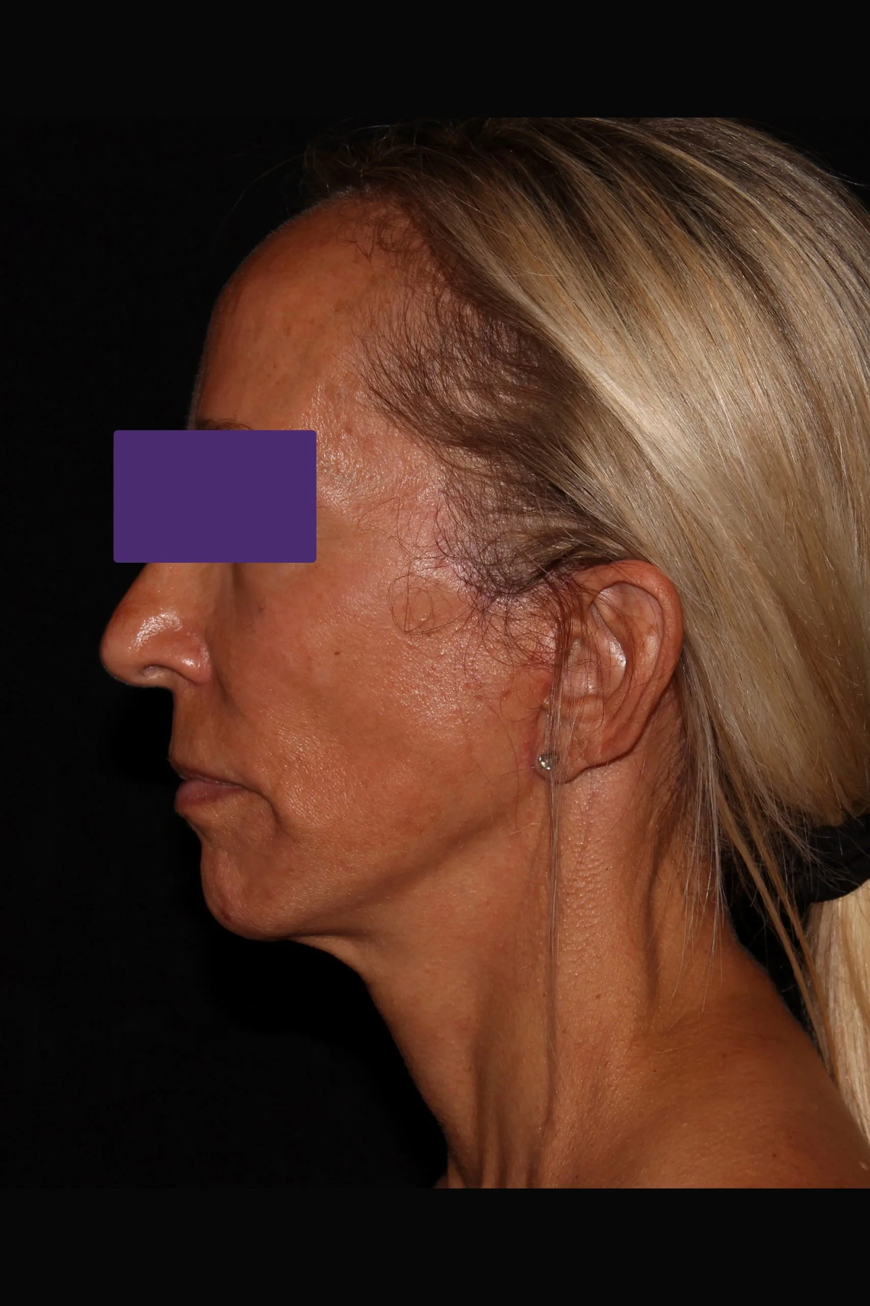 Case #5582 after_side