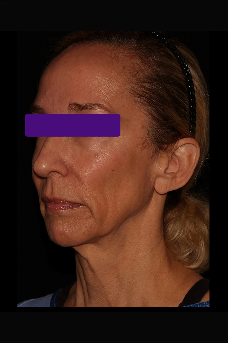 Case #5582 before_oblique_opt