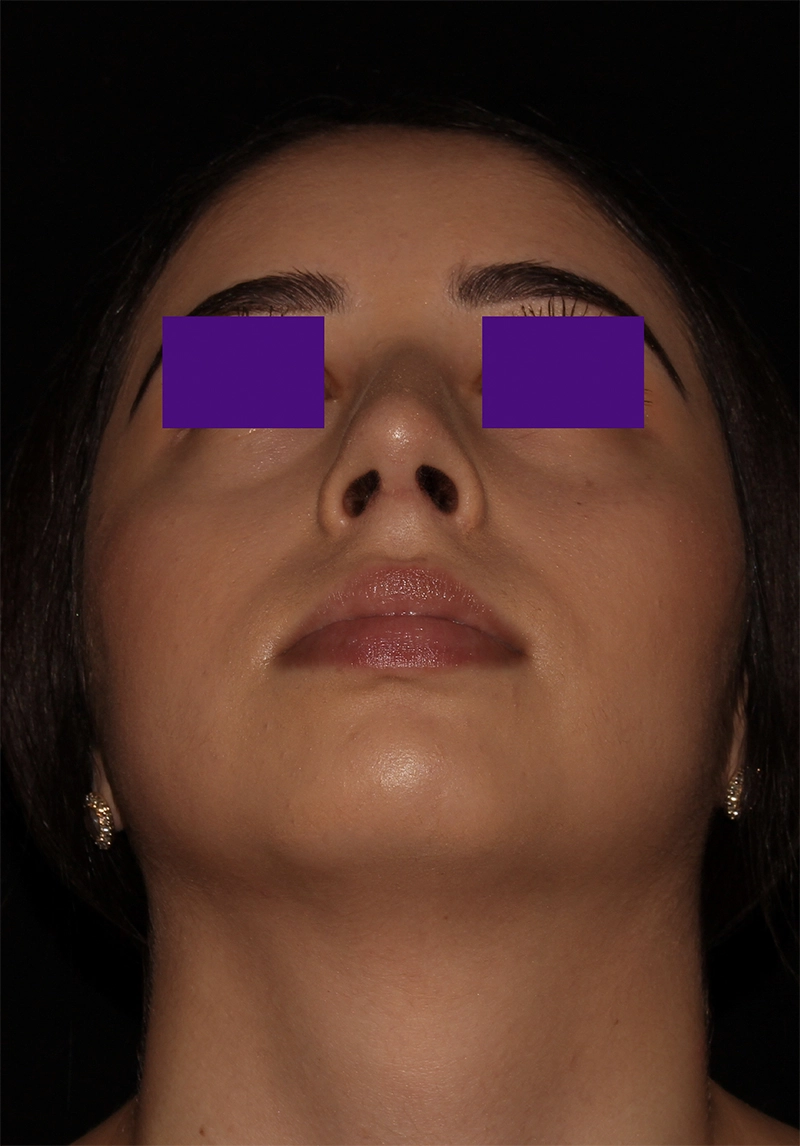 Case #5756 after_opt