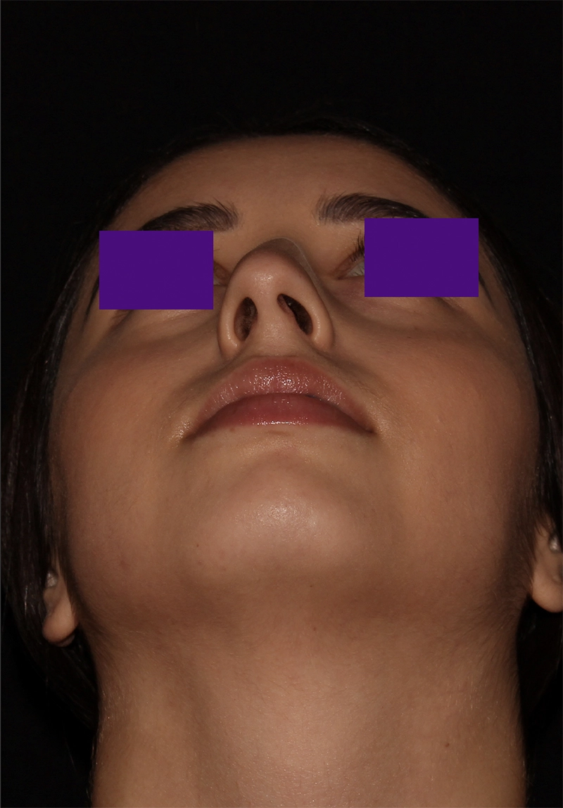 Case #5756 before_opt