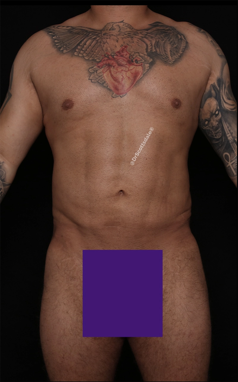 Case #872223 after_opt