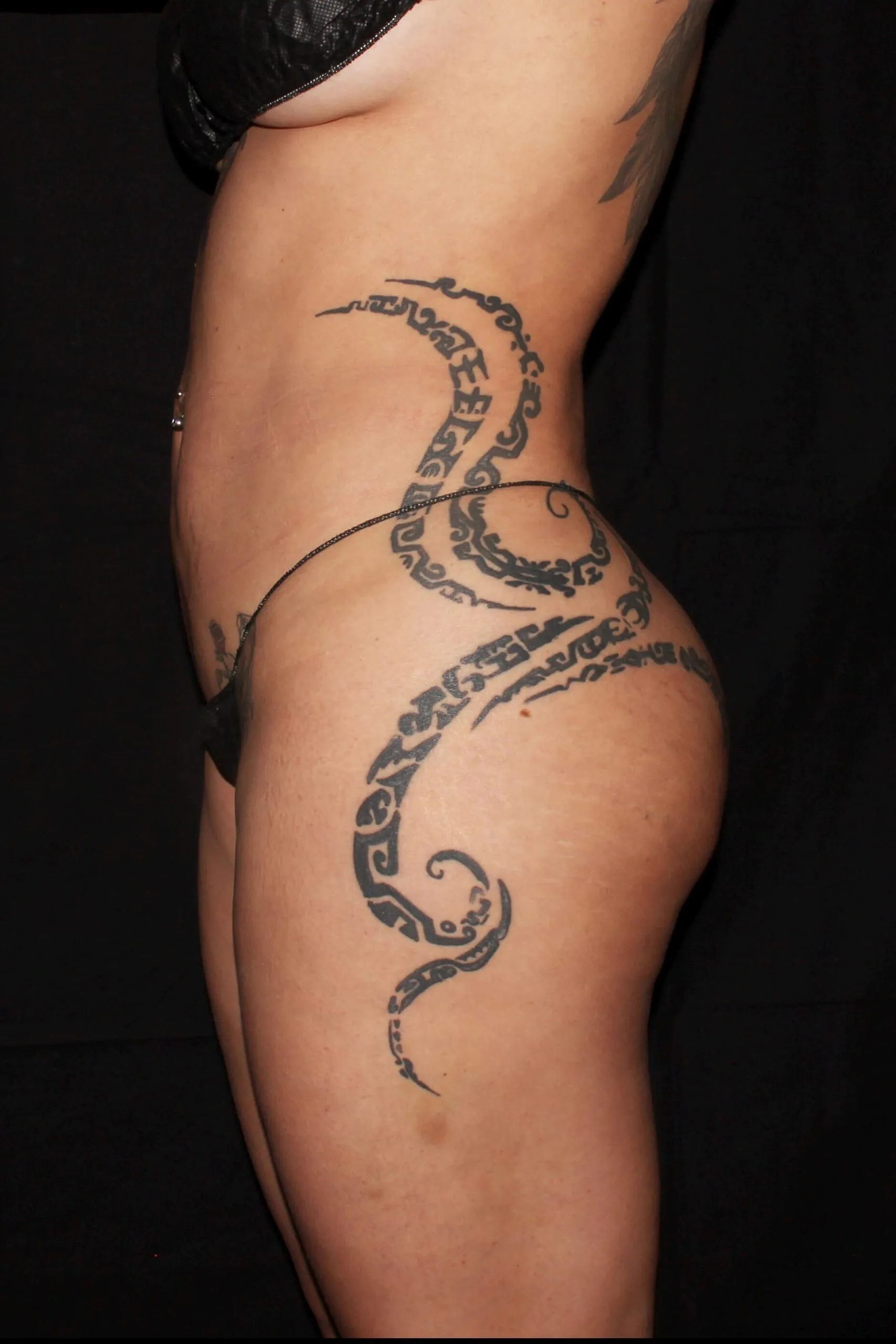 Liposuction After oblique 3 35130