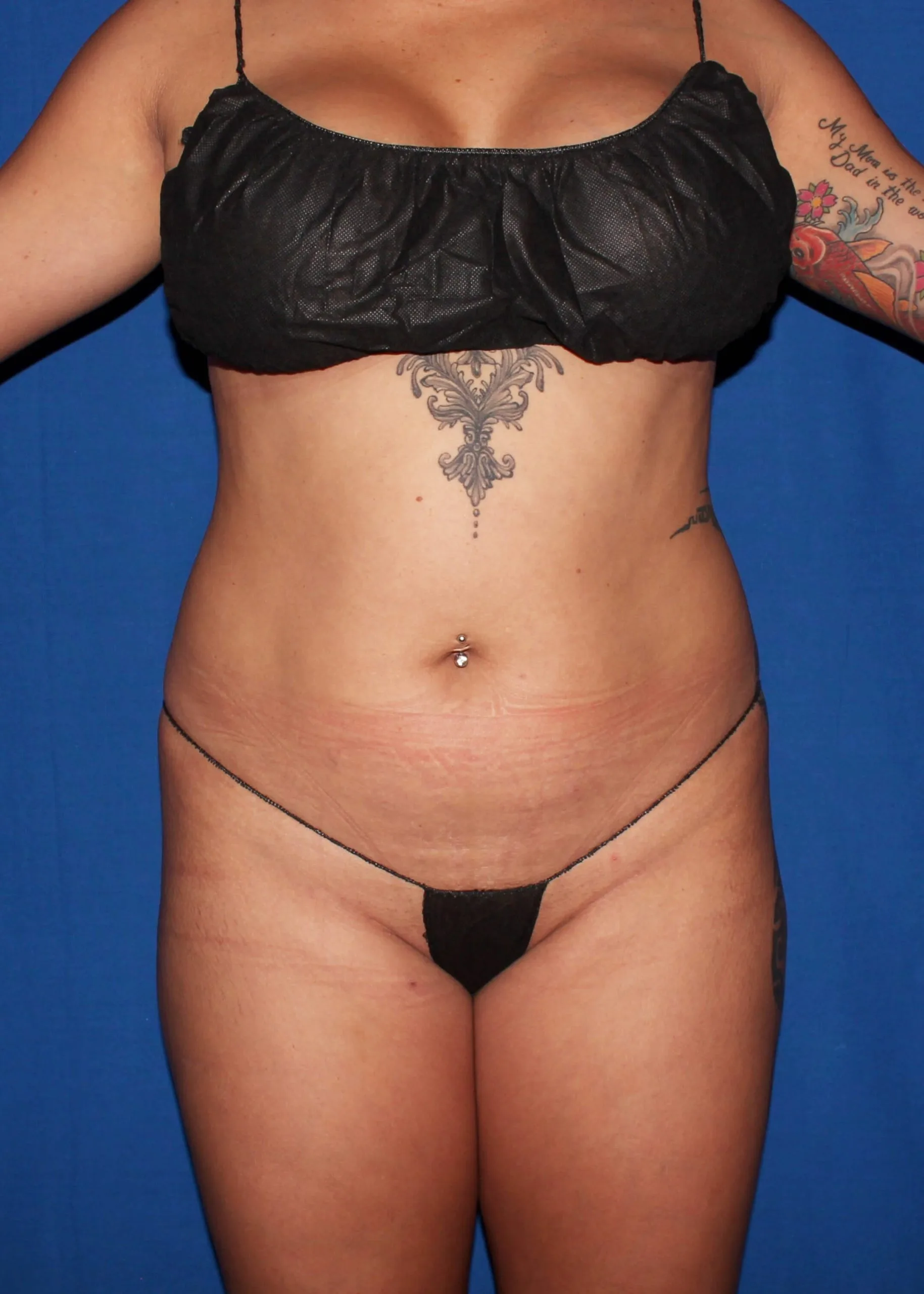 Liposuction Before 35130