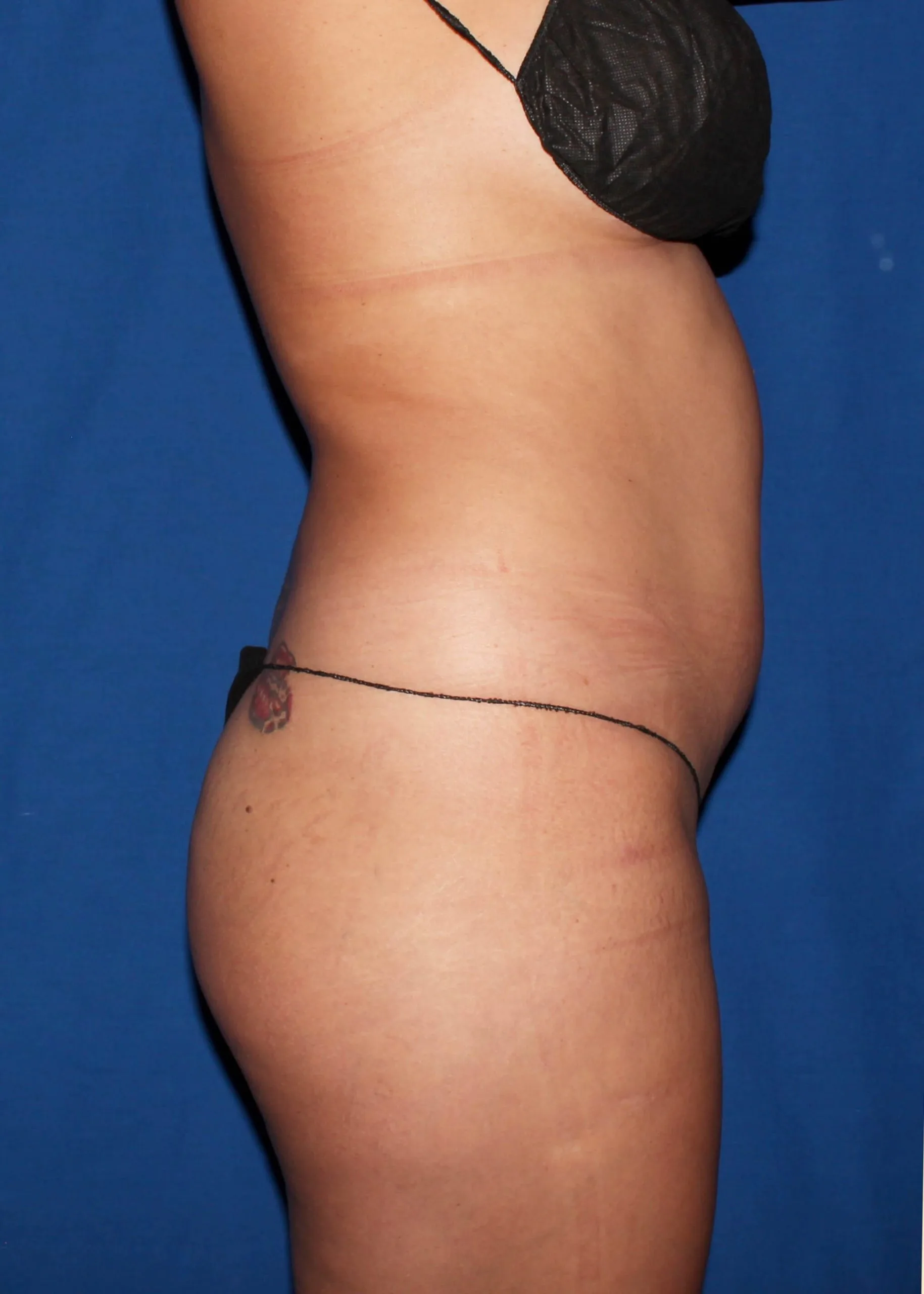 Liposuction Before oblique 2 35130