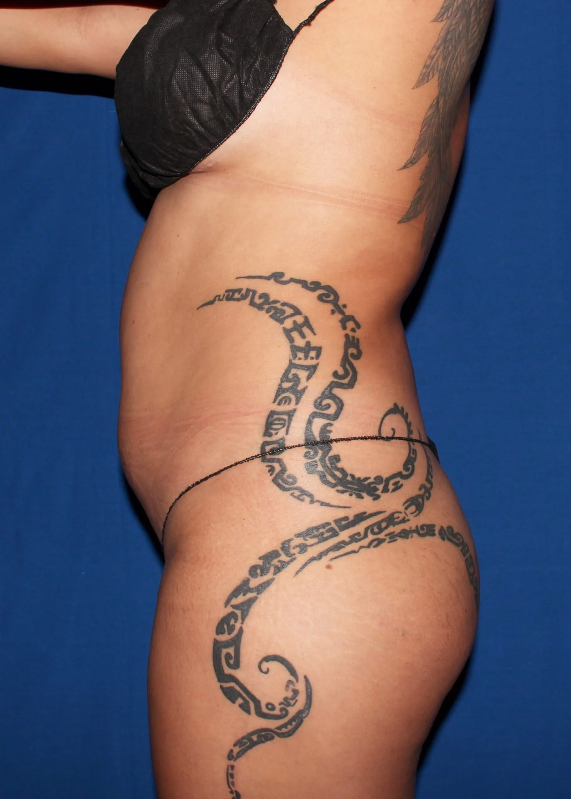 Liposuction Before oblique 3 35130