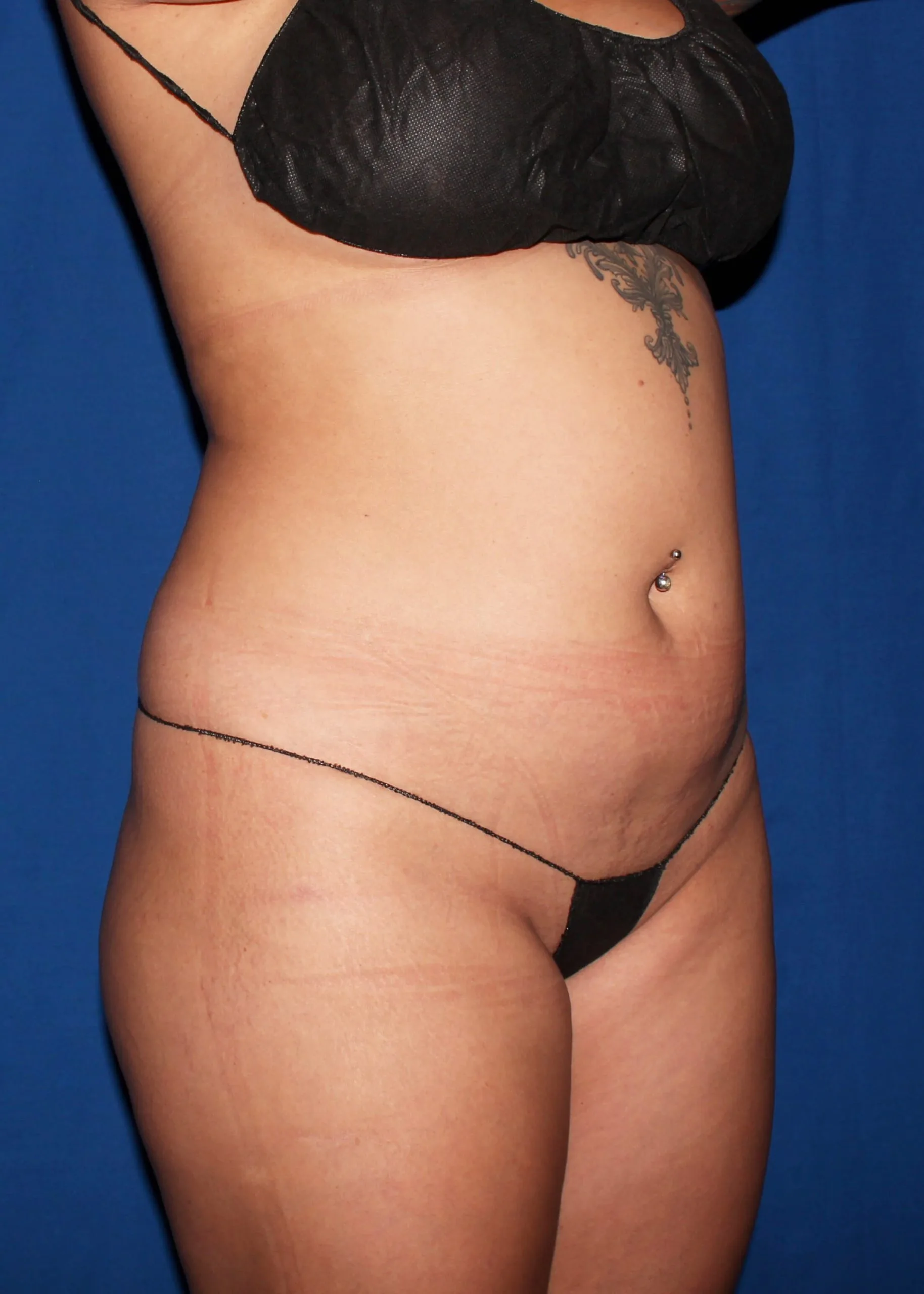 Liposuction Before oblique 35130