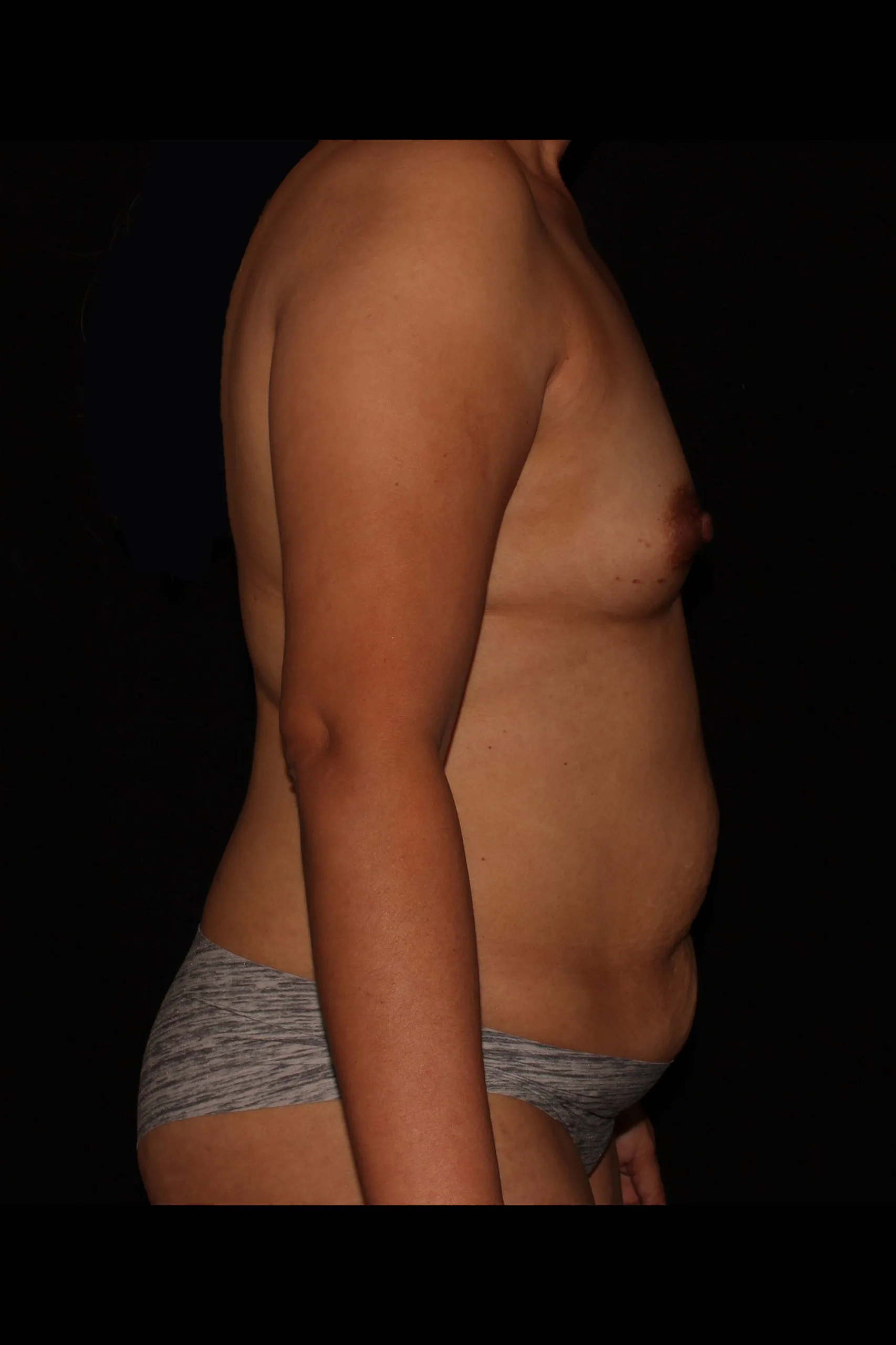 Mommy Makeover 4507 side