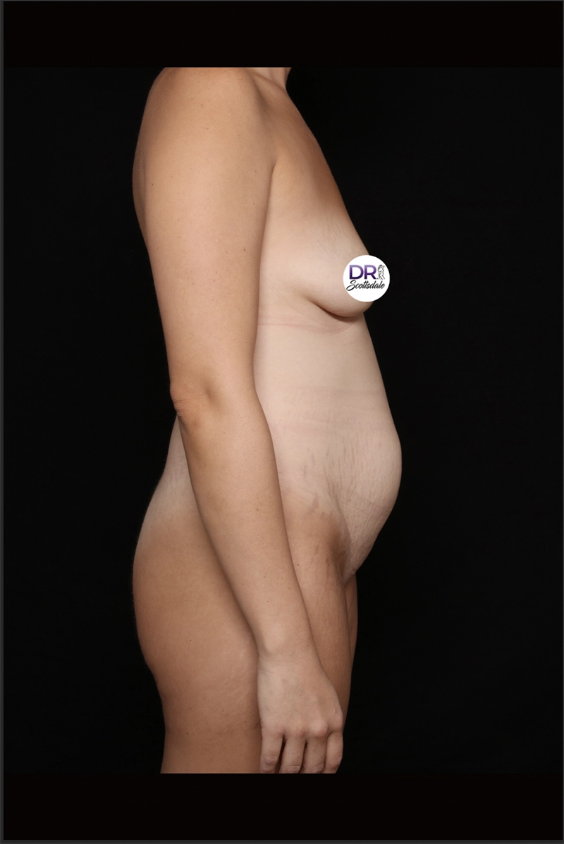 Mommy Makeover 847162_before_opt