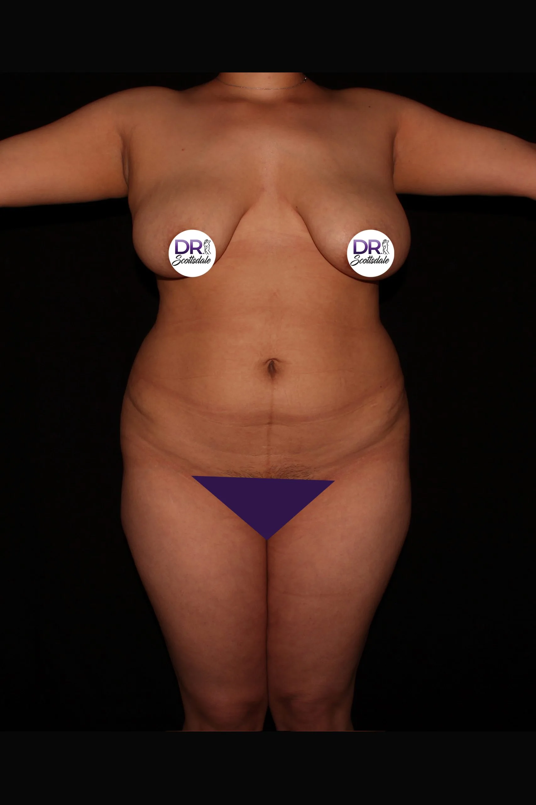 Scottsdale Skinny 5939 before front