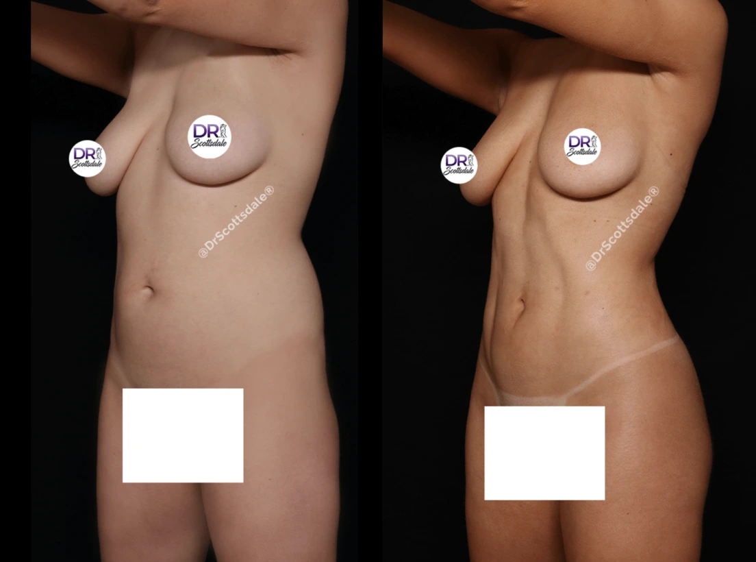 Liposuction Before & After Banner