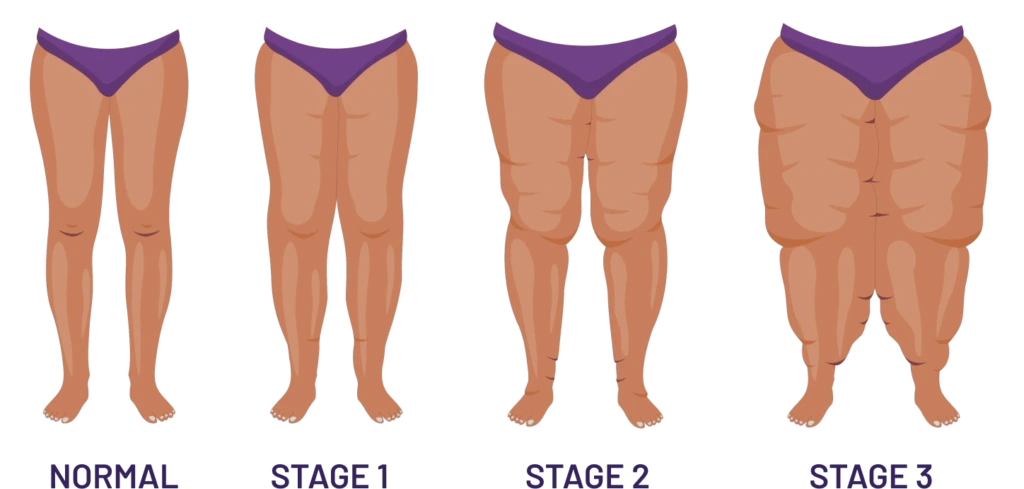 About Lipedema Surgery Banner