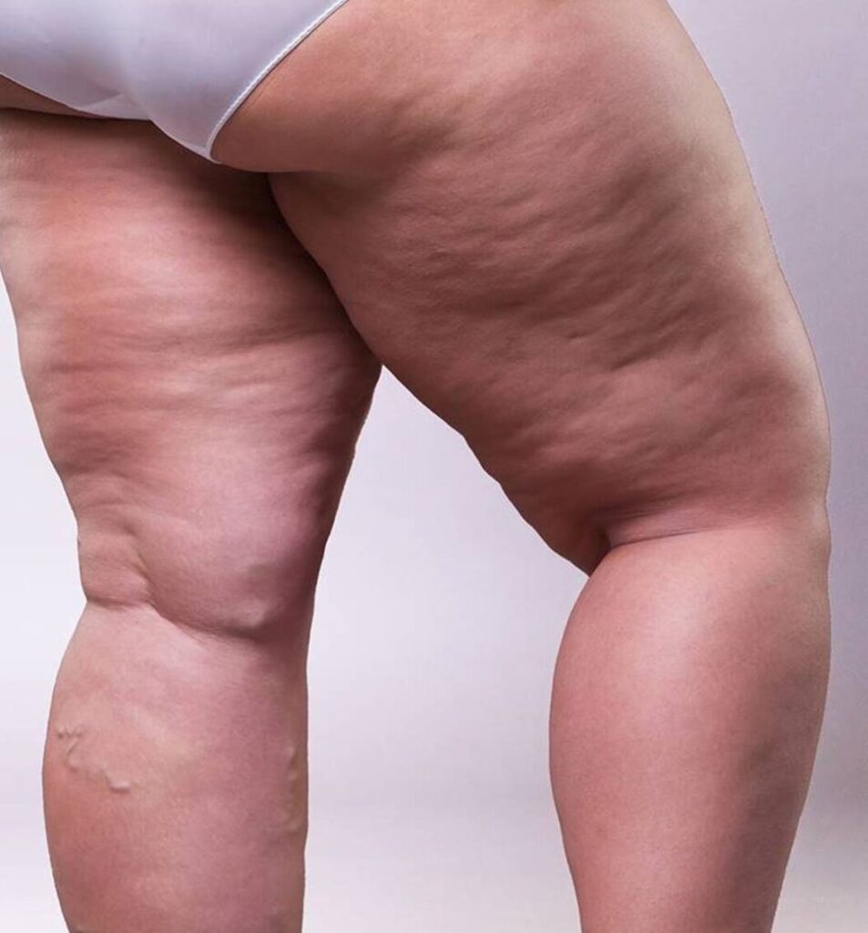 Consultation & Preparation For Lipedema Surgery Banner