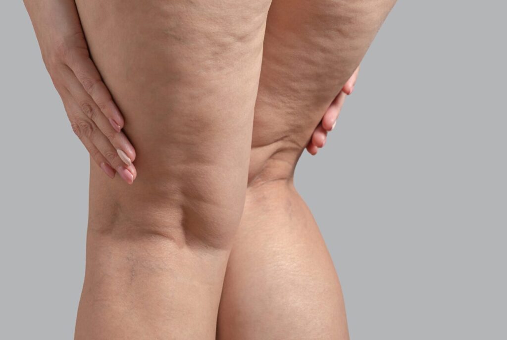 Recovery After Lipedema Surgery Banner